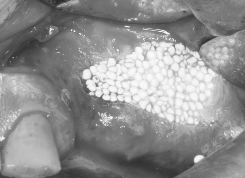 Eurocoating OsproLife® bone substitutes are calcium phosphate biomaterials used to fill bone voids or augment mechanically stabilized sites and can be provided as granules or aggregates