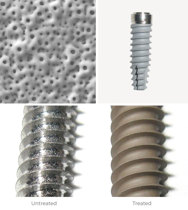 3D Growth titanium anodization – Lincotek Medical